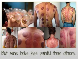 Cupping