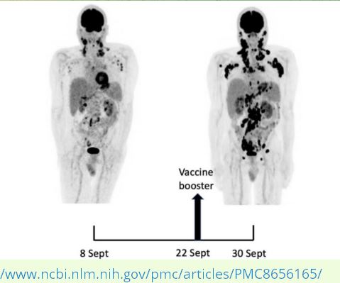 Sudden surge in cancer within weeks of C19 Jabs?